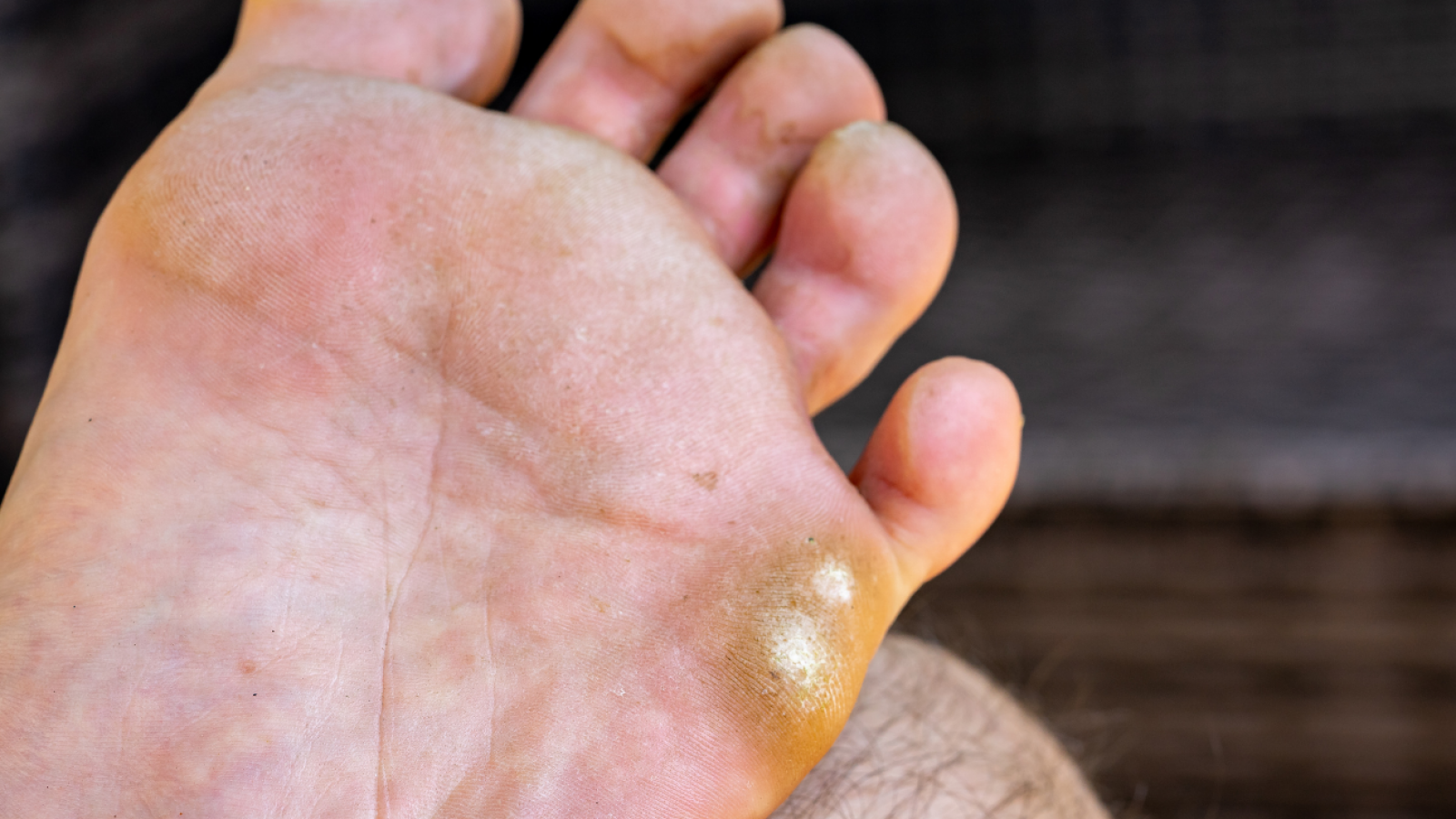 Pie de atleta: cuáles son sus síntomas y cómo se cura