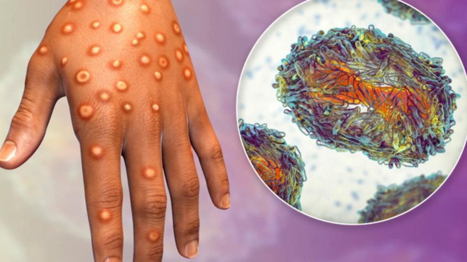 El gobierno de Mendoza dio detalles sobre la "viruela del mono" ante la alerta mundial